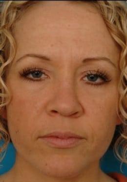 Rhinoplasty before at Saltz Plastic Surgery & Saltz Spa Vitoria in Salt Lake City, UT