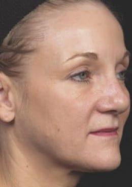 Microneedling after at Saltz Plastic Surgery & Saltz Spa Vitoria in Salt Lake City, UT