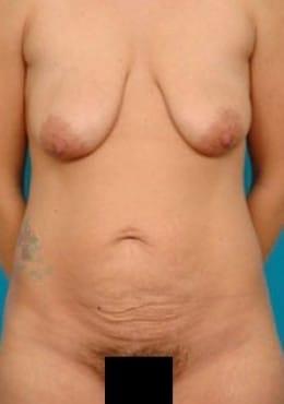 Mommy Makeover before at Saltz Plastic Surgery & Saltz Spa Vitoria in Salt Lake City, UT