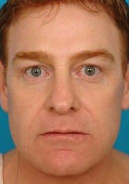 Saltz Plastic Surgery & Saltz Spa Vitoria facelift after — Salt Lake City, UT