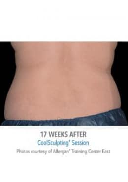 CoolSculpting after at Saltz Plastic Surgery & Saltz Spa Vitoria in Salt Lake City, UT