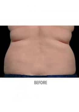 CoolSculpting before at Saltz Plastic Surgery & Saltz Spa Vitoria in Salt Lake City, UT