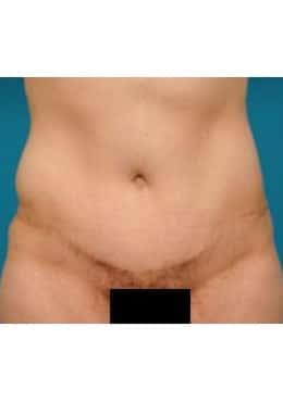 Saltz Plastic Surgery & Saltz Spa Vitoria liposuction after — Salt Lake City, UT
