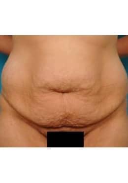 Liposuction before at Saltz Plastic Surgery & Saltz Spa Vitoria in Salt Lake City, UT