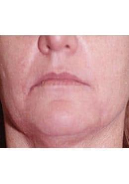 Lip Filler before at Saltz Plastic Surgery & Saltz Spa Vitoria in Salt Lake City, UT