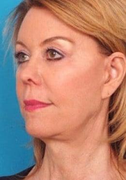 Saltz Plastic Surgery & Saltz Spa Vitoria facelift after — Salt Lake City, UT