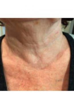 Microneedling after at Saltz Plastic Surgery & Saltz Spa Vitoria in Salt Lake City, UT