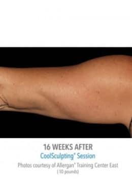 CoolSculpting after at Saltz Plastic Surgery & Saltz Spa Vitoria in Salt Lake City, UT