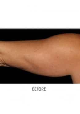 CoolSculpting before at Saltz Plastic Surgery & Saltz Spa Vitoria in Salt Lake City, UT