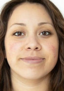 Chemical Peel before at Saltz Plastic Surgery & Saltz Spa Vitoria in Salt Lake City, UT