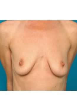 Breast Augmentation before at Saltz Plastic Surgery & Saltz Spa Vitoria in Salt Lake City, UT