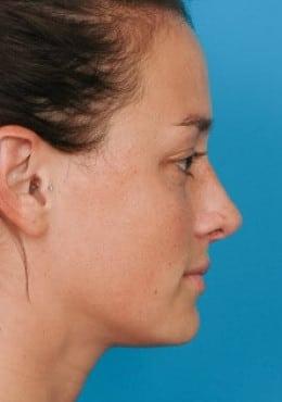 Saltz Plastic Surgery & Saltz Spa Vitoria rhinoplasty after — Salt Lake City, UT