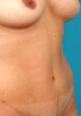Saltz Plastic Surgery & Saltz Spa Vitoria liposuction after — Salt Lake City, UT