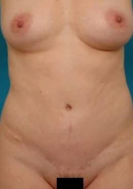 Saltz Plastic Surgery & Saltz Spa Vitoria tummy tuck after — Salt Lake City, UT