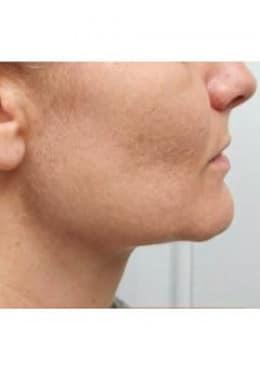Microneedling after at Saltz Plastic Surgery & Saltz Spa Vitoria in Salt Lake City, UT