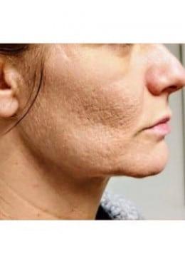 Microneedling before at Saltz Plastic Surgery & Saltz Spa Vitoria in Salt Lake City, UT
