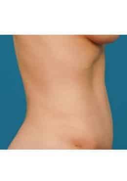 Tummy Tuck after at Saltz Plastic Surgery & Saltz Spa Vitoria in Salt Lake City, UT