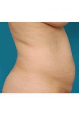Tummy Tuck before at Saltz Plastic Surgery & Saltz Spa Vitoria in Salt Lake City, UT