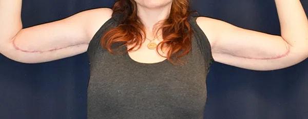 Dr. Won Cosmetic Surgery arm lift after — Shoreline, WA