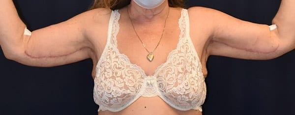 Dr. Won Cosmetic Surgery arm lift after — Shoreline, WA