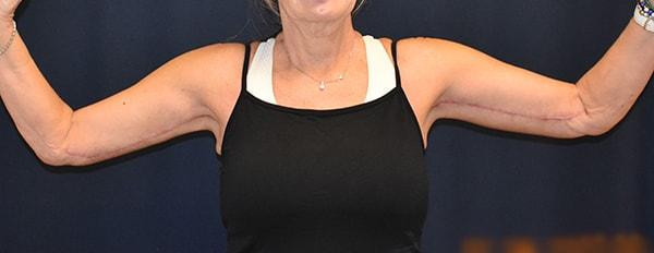 Dr. Won Cosmetic Surgery arm lift after — Shoreline, WA