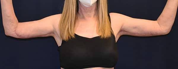 Dr. Won Cosmetic Surgery arm lift after — Shoreline, WA