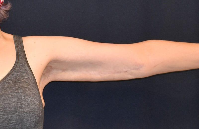 Dr. Won Cosmetic Surgery arm lift after — Shoreline, WA