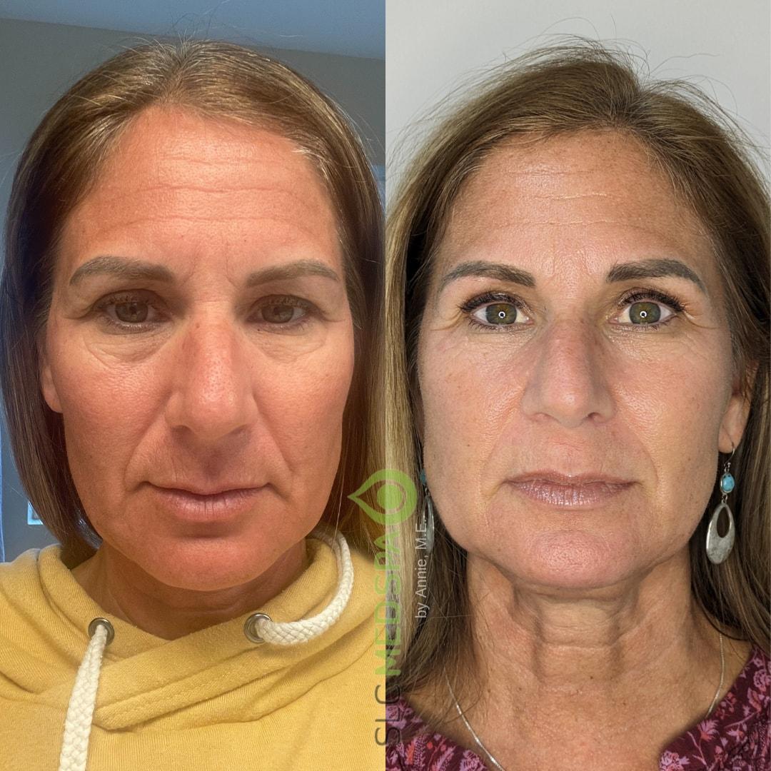 SLC Med Spa morpheus8 result — Draper, UT