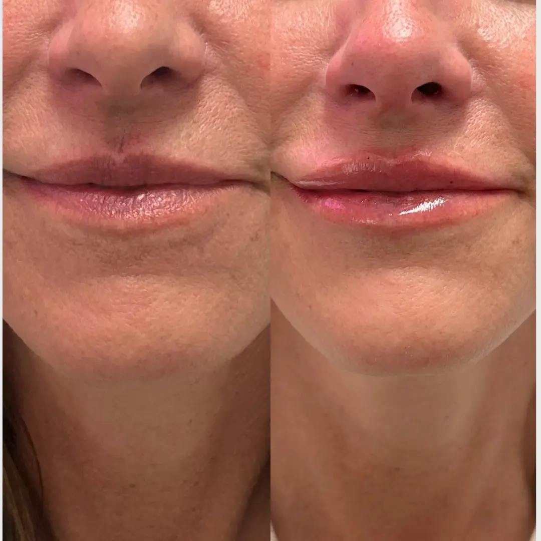 SLC Med Spa lip filler result — Draper, UT