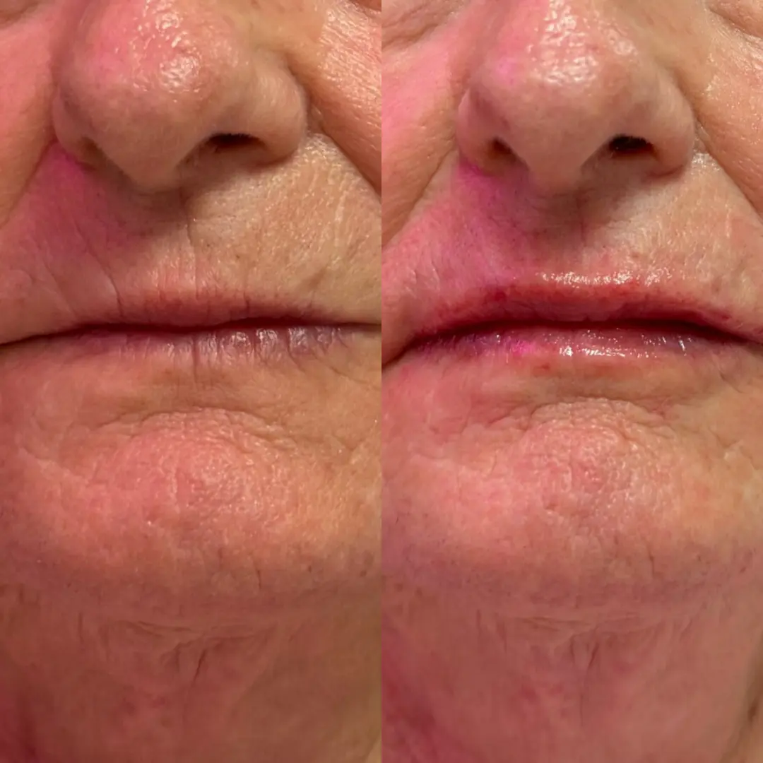 SLC Med Spa result — Draper, UT