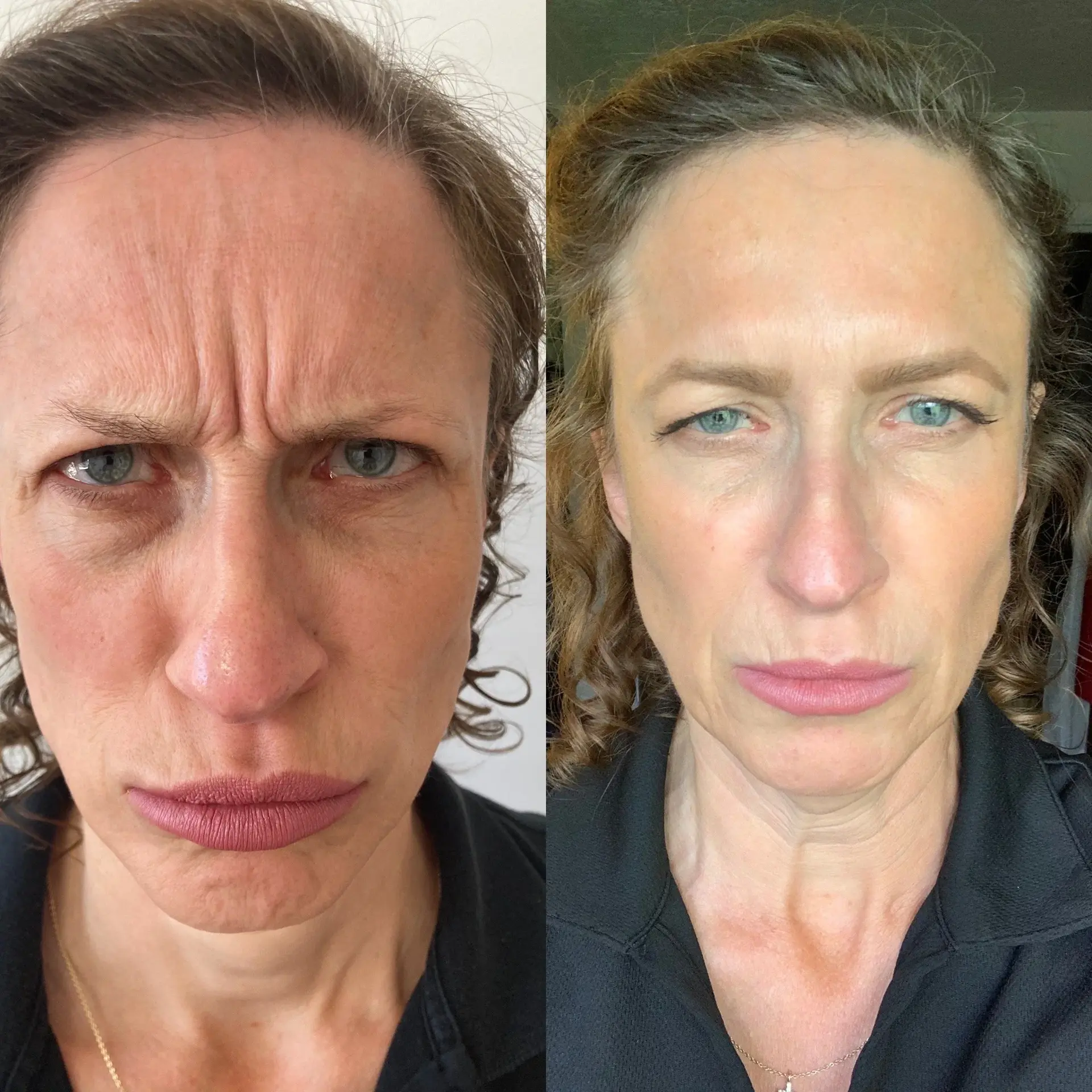 SLC Med Spa result — Draper, UT