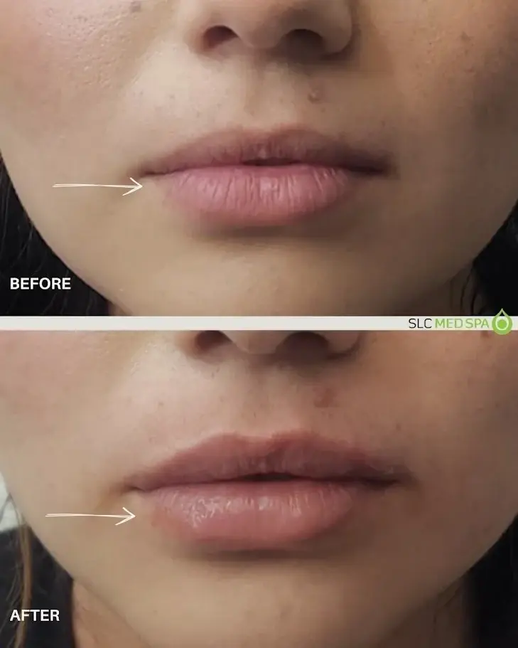 SLC Med Spa lip filler result — Draper, UT