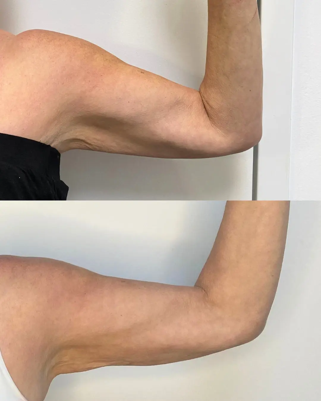 SLC Med Spa skin tightening result — Draper, UT