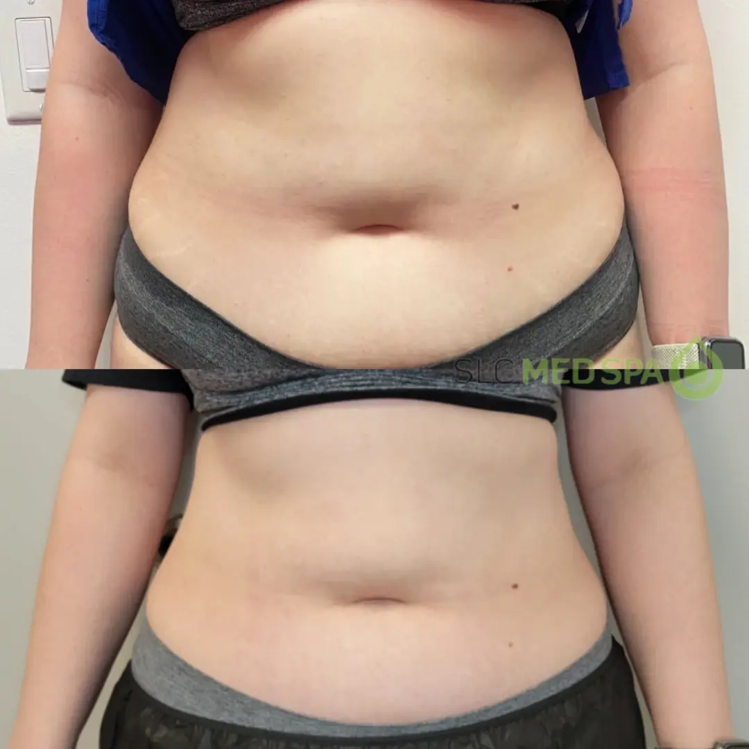 SLC Med Spa morpheus8 result — Draper, UT
