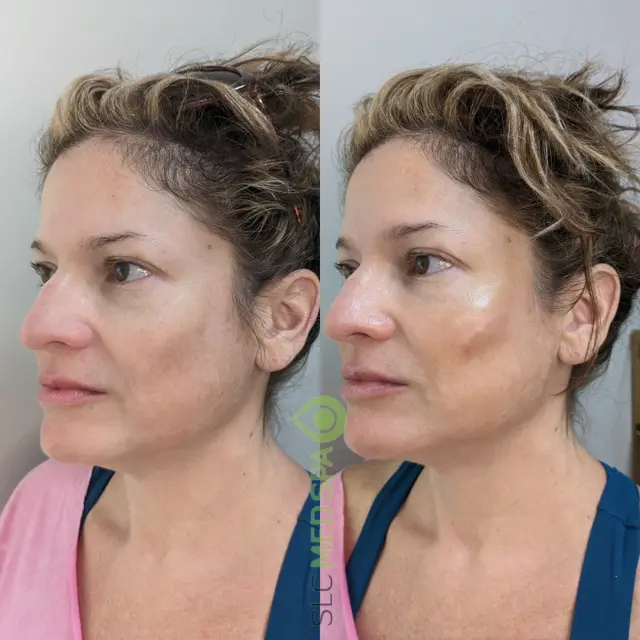 Dermal Fillers result at SLC Med Spa in Draper, UT