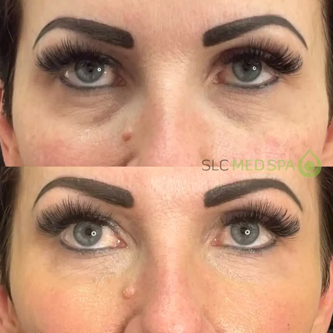 SLC Med Spa under-eye filler result — Draper, UT