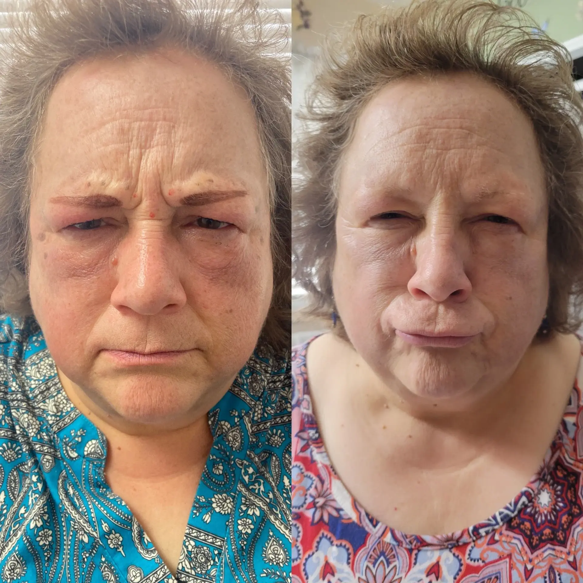 SLC Med Spa result — Draper, UT