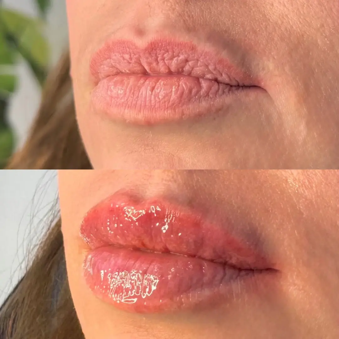 SLC Med Spa lip filler result — Draper, UT