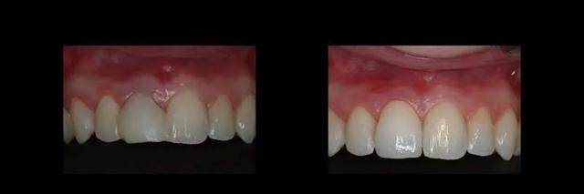 Dental Implants result at The Dental Studio in Sandy, UT
