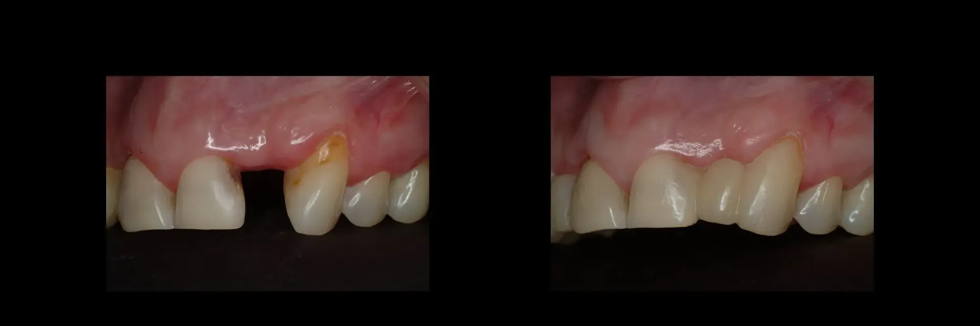 The Dental Studio dental crowns result — Sandy, UT