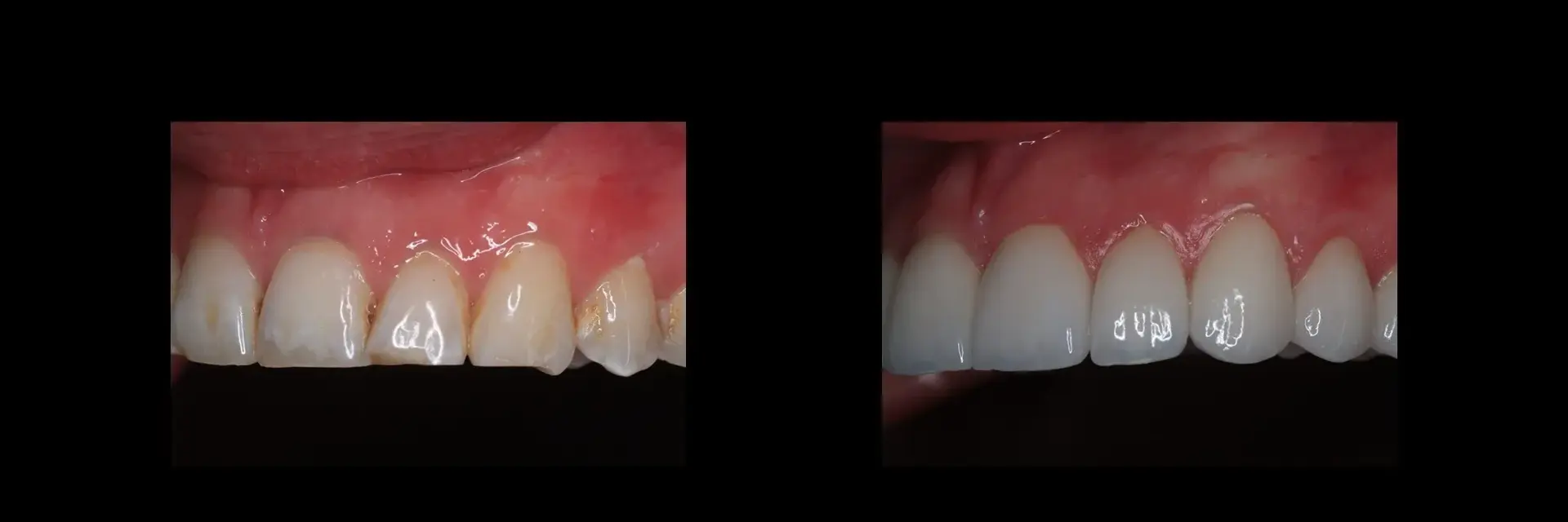 The Dental Studio veneers result — Sandy, UT