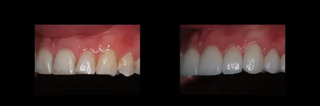 Dental Veneers result at The Dental Studio in Sandy, UT