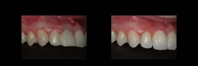 Dental Implants result at The Dental Studio in Sandy, UT