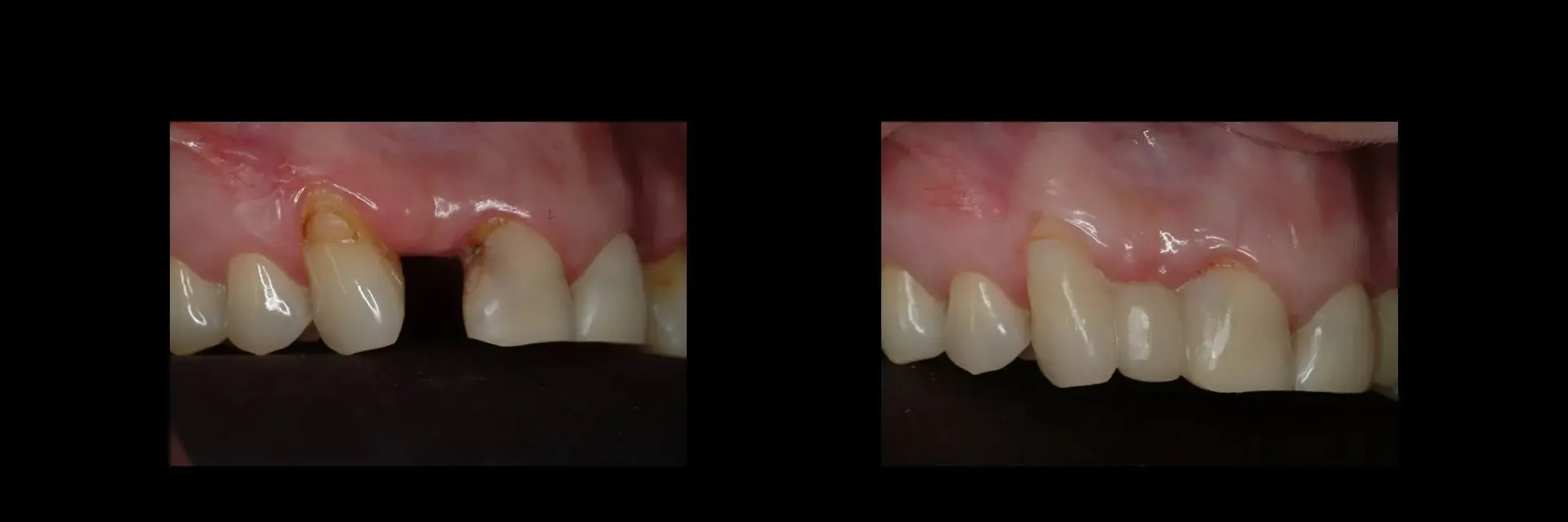The Dental Studio dental crowns result — Sandy, UT