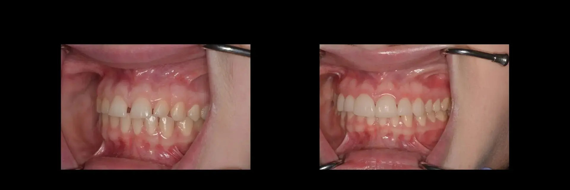The Dental Studio veneers result — Sandy, UT