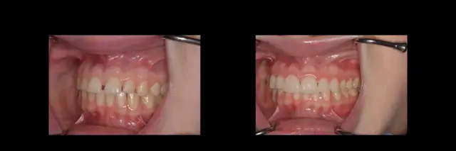 Dental Veneers result at The Dental Studio in Sandy, UT