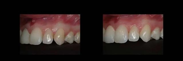 Dental Implants result at The Dental Studio in Sandy, UT