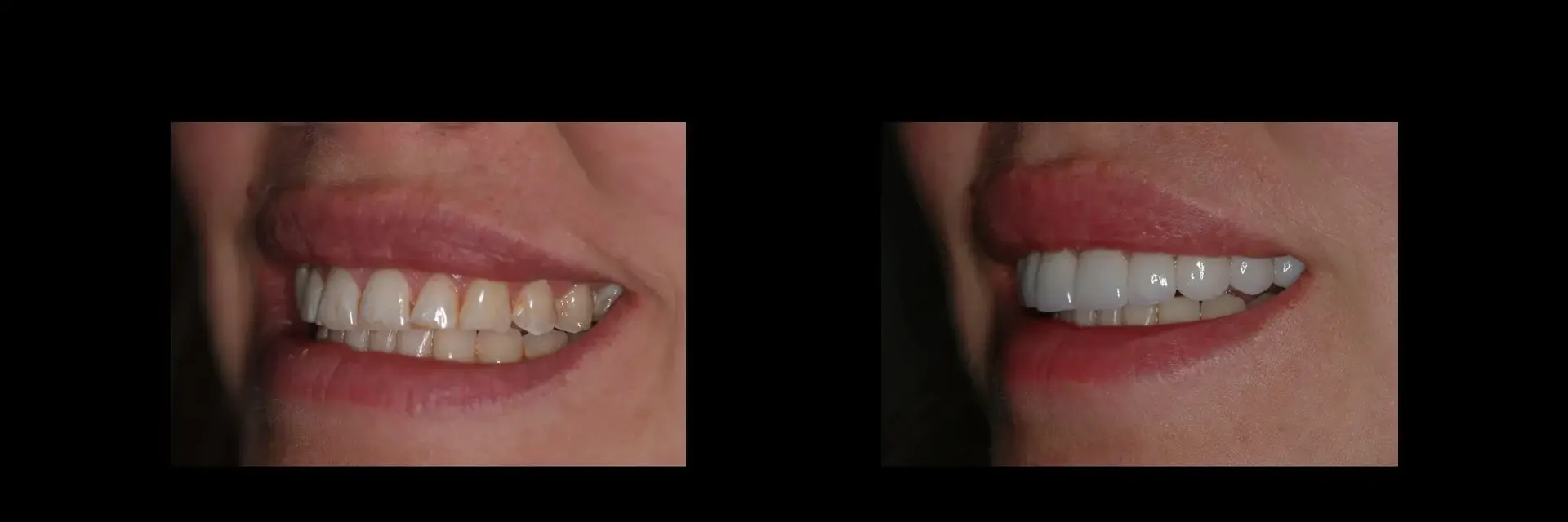 The Dental Studio veneers result — Sandy, UT