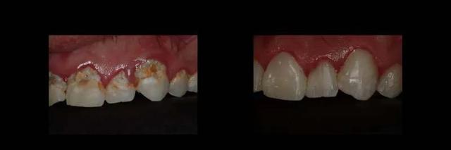 Smile Makeover result at The Dental Studio in Sandy, UT