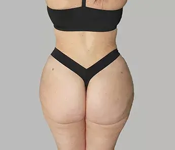 Brazilian Butt Lift after at The Skin Center in Columbus, OH